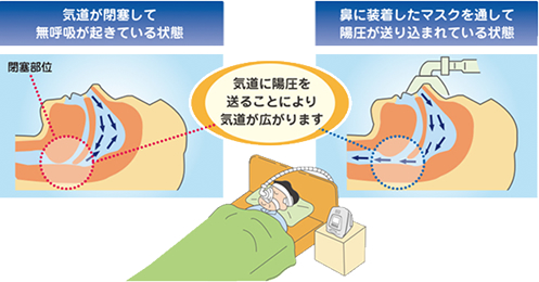 睡眠時無呼吸症候群と心臓リハビリ ― 未来を守る医療